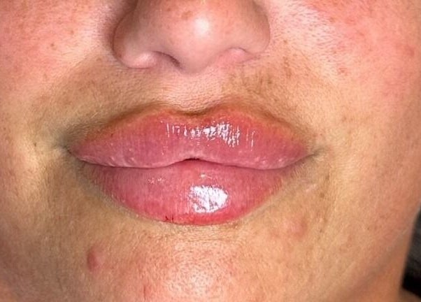 Close-up of luscious lips after treatment at Aspinall Aesthetics in Kingswood, England, GB.
