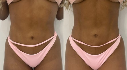 Before and after body contouring at Tone & Glow, Stanstead Abbotts, England, GB.