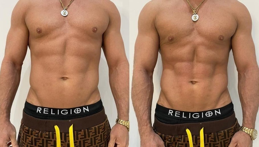 Before and after body contouring at Tone & Glow, Stanstead Abbotts, England, GB showcasing toned abs.