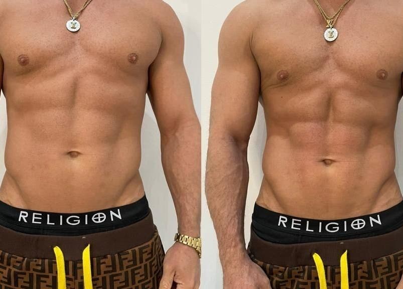 Before and after body contouring at Tone & Glow, Stanstead Abbotts, England, GB showcasing toned abs.