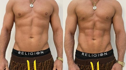 Before and after body contouring at Tone & Glow, Stanstead Abbotts, England, GB showcasing toned abs.