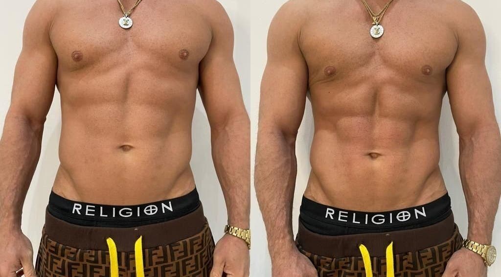 Before and after body contouring at Tone & Glow, Stanstead Abbotts, England, GB showcasing toned abs.