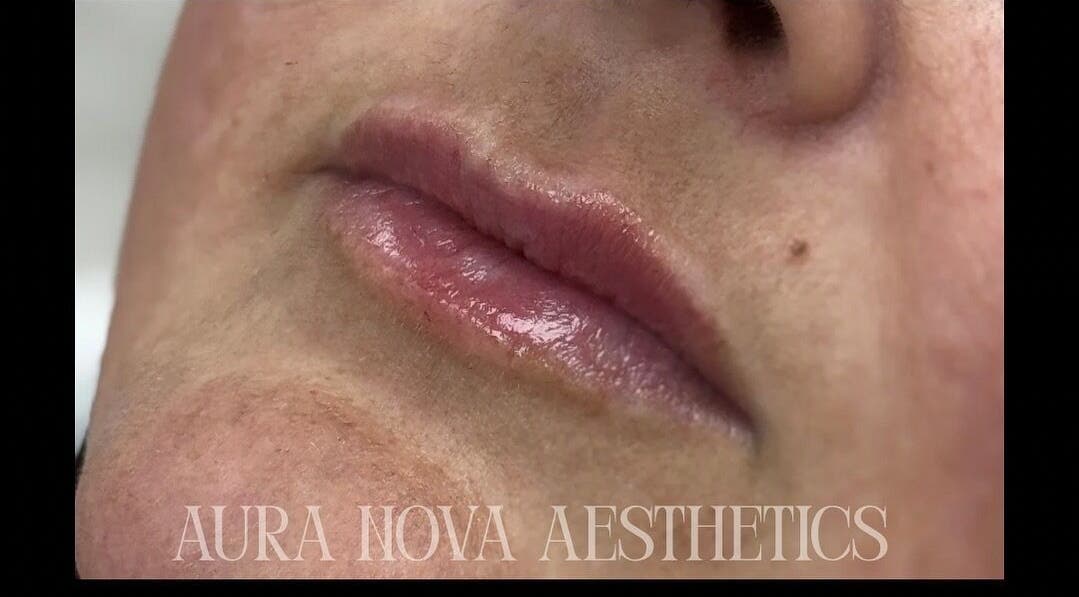 Glossy lips treatment at Aura Nova Aesthetics & Beauty, Royal Tunbridge Wells, England, GB.