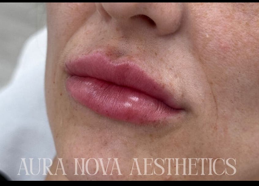Close-up of enhanced lips at Aura Nova Aesthetics & Beauty, Royal Tunbridge Wells, England, GB.