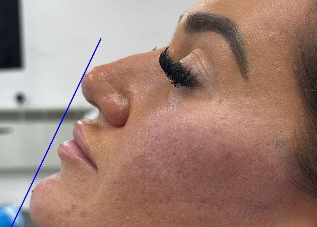 Profile treatment at Aura Nova Aesthetics & Beauty in Royal Tunbridge Wells, England, GB accentuates natural beauty.