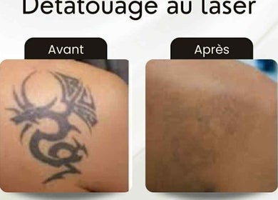 Résultats du détatouage laser avant et après chez Odyssee derme, Brossard, Québec, CA.