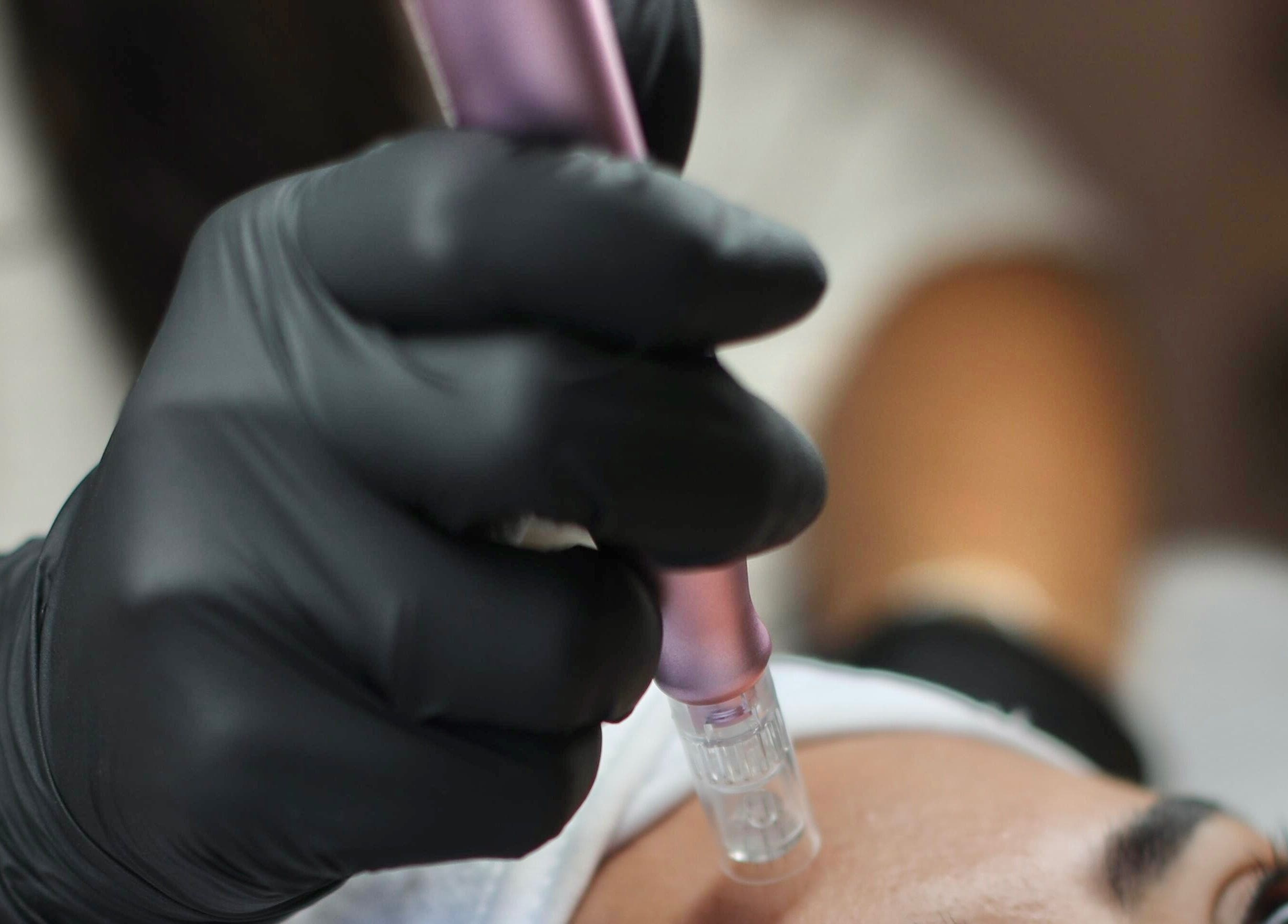 Behandeling bij Bless Esthetic Leuven, Leuven, Vlaanderen, BE met microneedling voor huidverjonging.