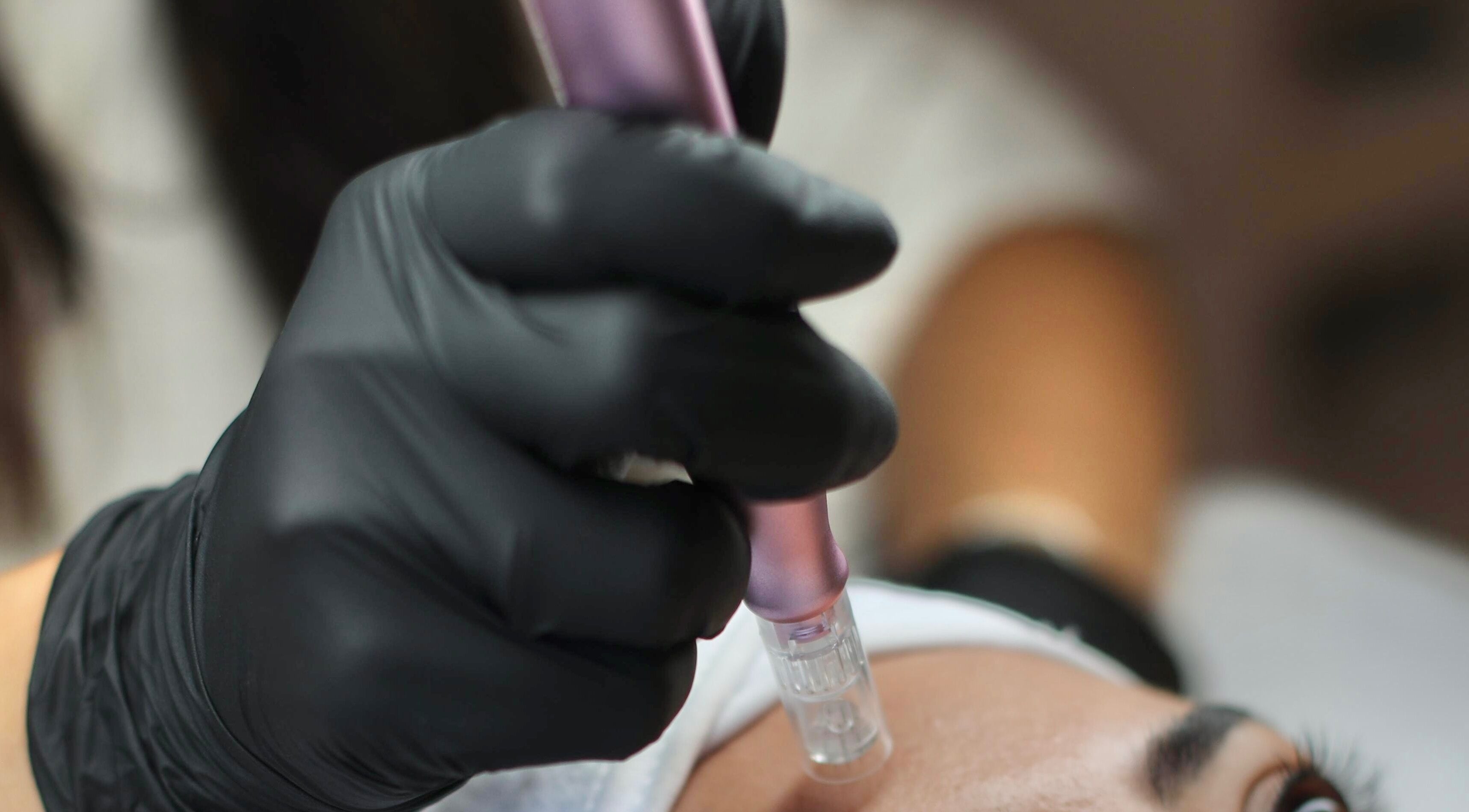 Behandeling bij Bless Esthetic Leuven, Leuven, Vlaanderen, BE met microneedling voor huidverjonging.