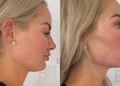 Side profile before and after treatment at The Sculpt Studio EST 2018, Sketty, Wales, GB.