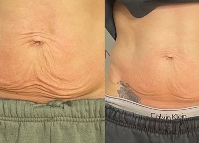 Skin tightening results at The Sculpt Studio EST 2018, Sketty, Wales, GB. Before and after treatment comparison.
