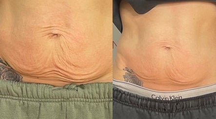 Skin tightening results at The Sculpt Studio EST 2018, Sketty, Wales, GB. Before and after treatment comparison.