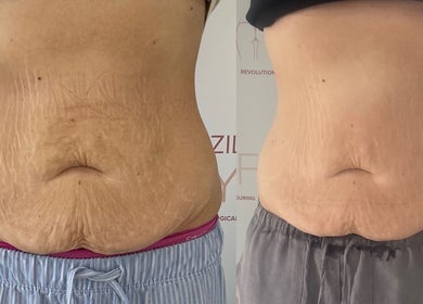 Before and after body contouring at The Sculpt Studio EST 2018, Sketty, Wales, GB.