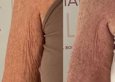 Before and after arm skin treatment at The Sculpt Studio EST 2018, Sketty, Wales, GB.