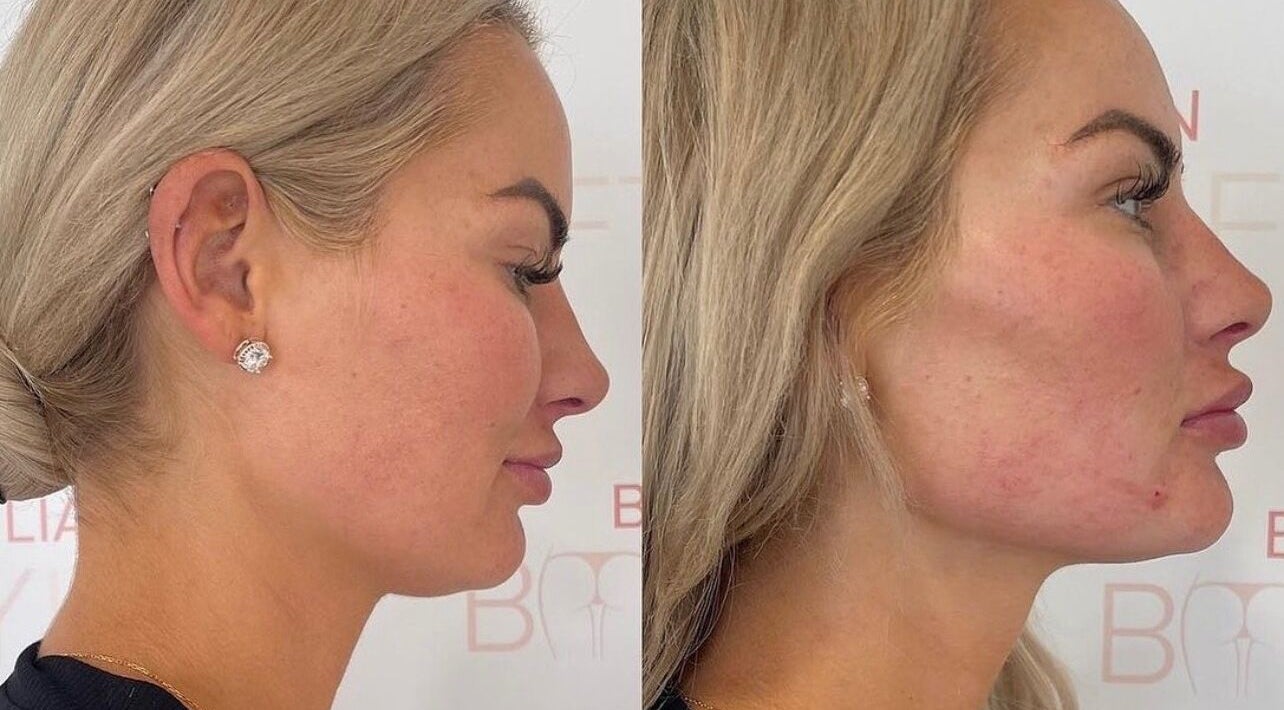 Profile transformation at The Sculpt Studio EST 2018, Sketty, Wales, GB, showcasing beauty enhancements.