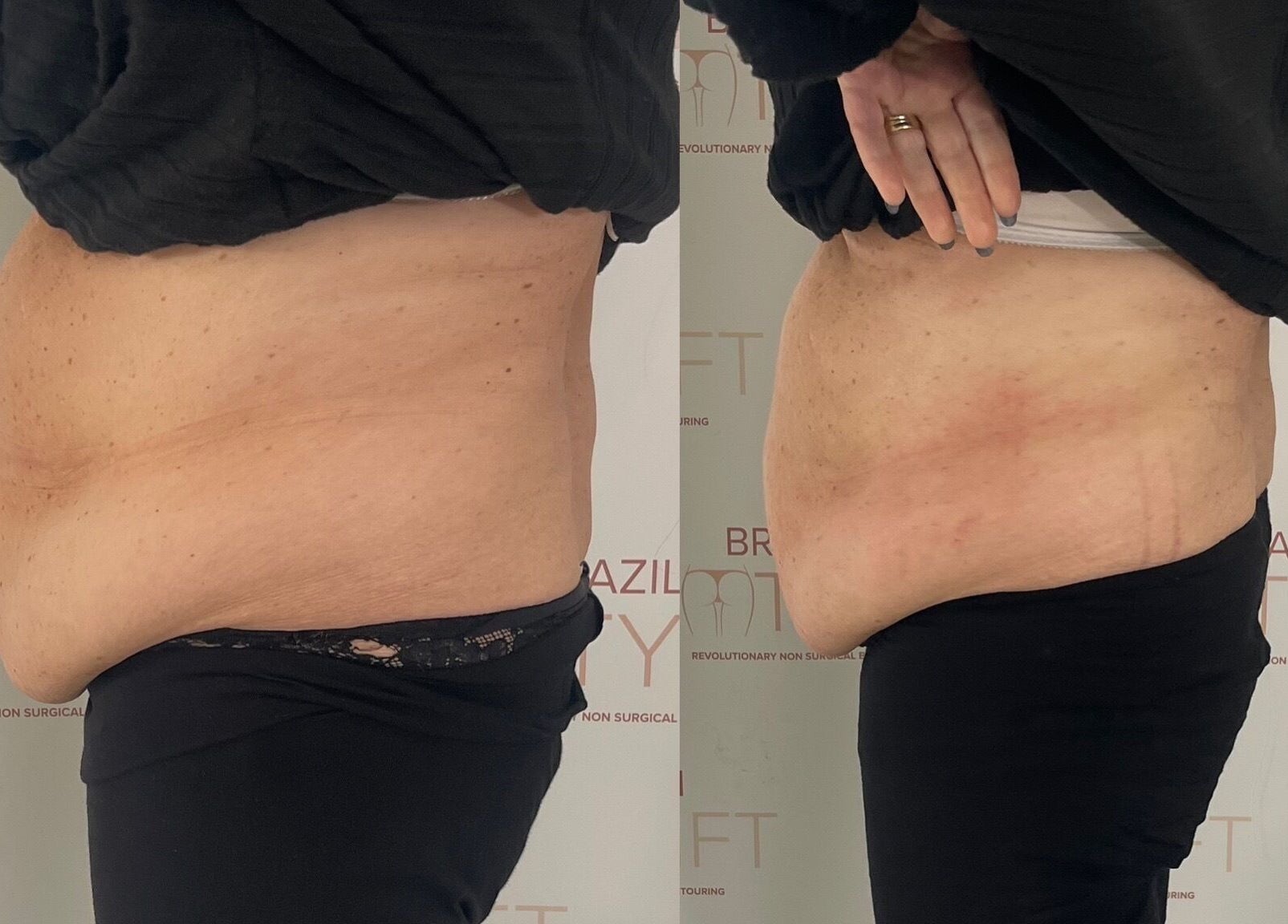 Before and after body contouring at The Sculpt Studio EST 2018, Sketty, Wales, GB.
