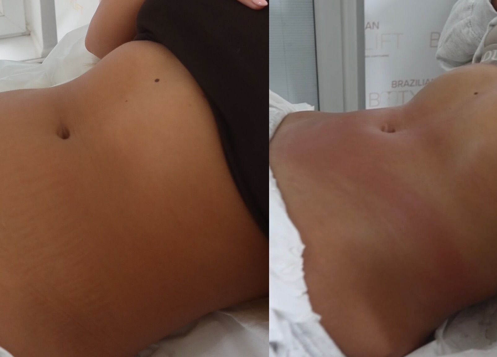 Body contouring results at The Sculpt Studio EST 2018, Sketty, Wales, GB.