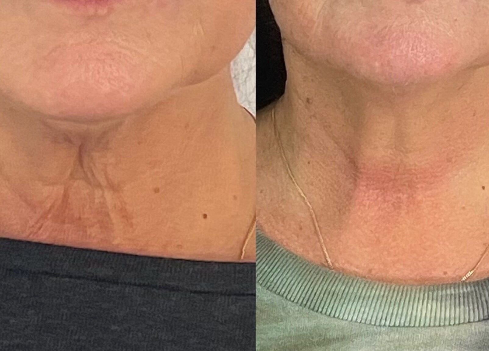 Before and after neck treatment at The Sculpt Studio EST 2018, Sketty, Wales, GB.