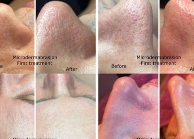 Microdermabrasion results at Lushious Luxuries, Belfast, Northern Ireland, GB, showcasing visible skin improvement.