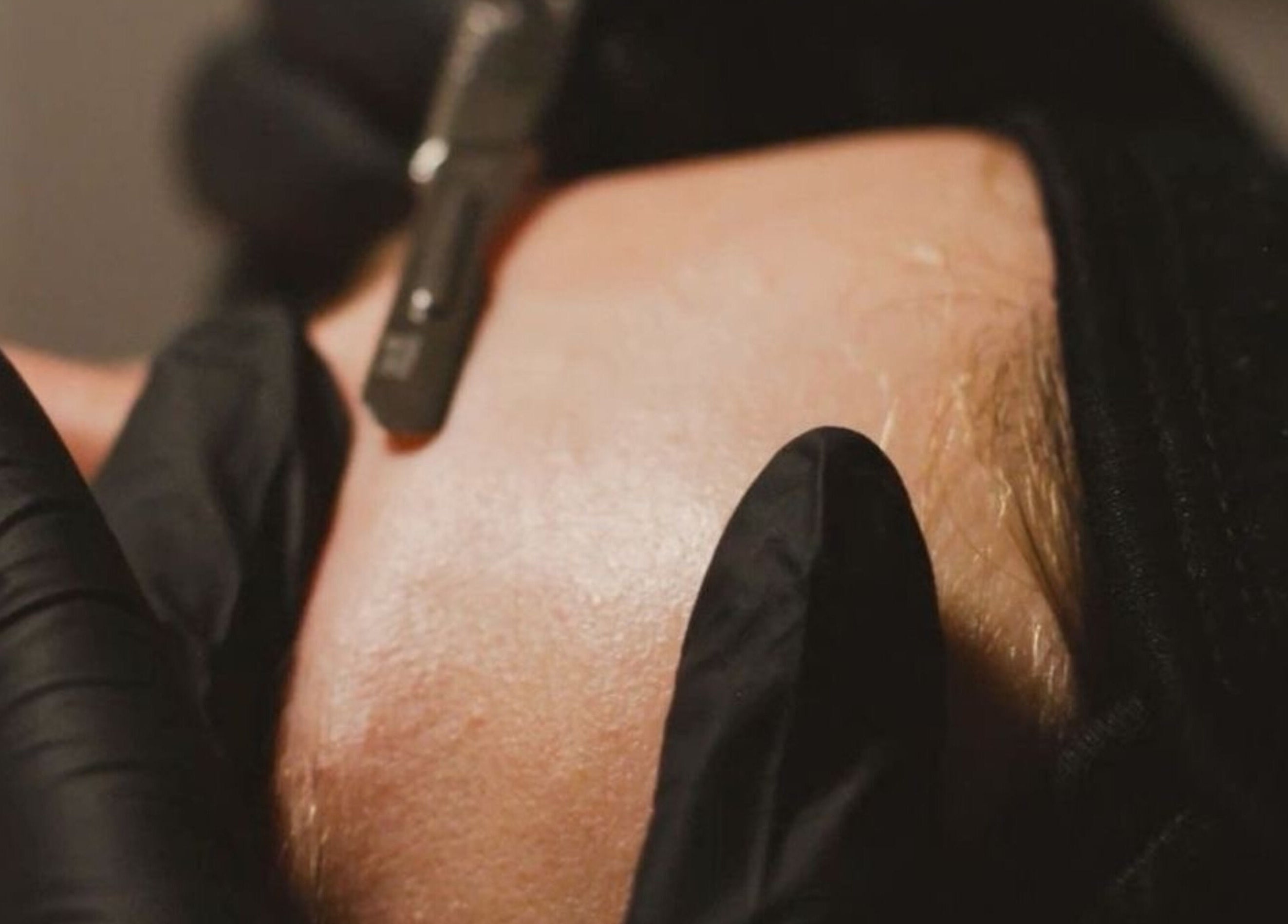 Facial treatment with precision tool at Studio Twenty2, Heddon-on-the-Wall, England, GB.