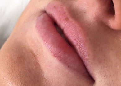 Close-up of lips after treatment at LS Aesthetics, Miskin, Wales, GB for a natural, plump look.