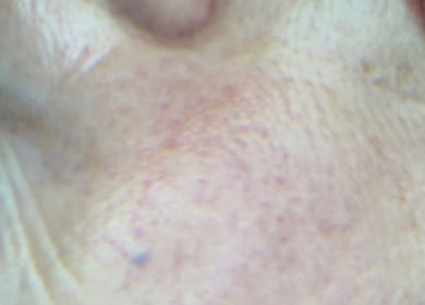 Close-up of facial skin showing texture at Marie Randall Skin Clinic, Syston, England, GB.