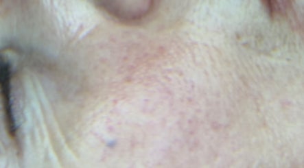 Close-up of facial skin showing texture at Marie Randall Skin Clinic, Syston, England, GB.