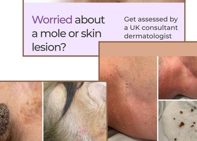 Marie Randall Skin Clinic in Syston, England offers mole and skin lesion assessments by expert dermatologists.