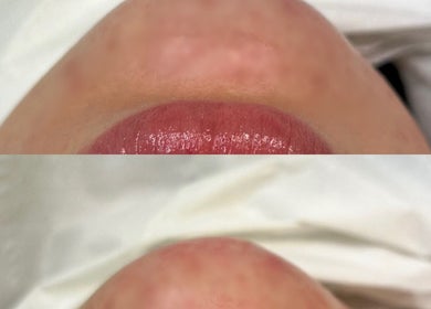 Close-up of polished lips during treatment at Gabrielle Aesthetics, Lichfield, England, GB.