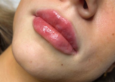 Close-up of enhanced lips at Gabrielle Aesthetics, Lichfield, England, GB.
