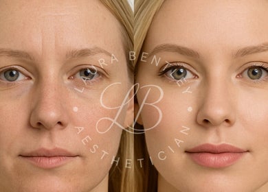 Before and after beauty treatment at Laura Bentley, Solihull, England, GB. Visible skin enhancement.