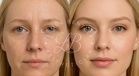 Before and after beauty treatment at Laura Bentley, Solihull, England, GB. Visible skin enhancement.
