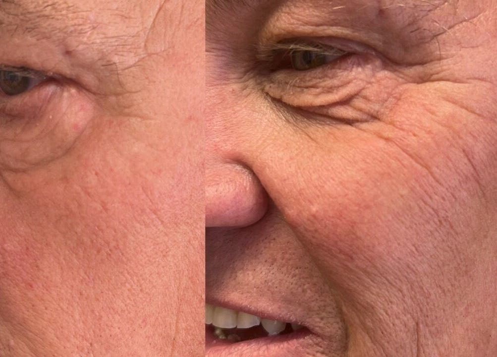 Before and after skin treatment at Lowes Lashes Aesthetics Sunbed, Faversham, England, GB.