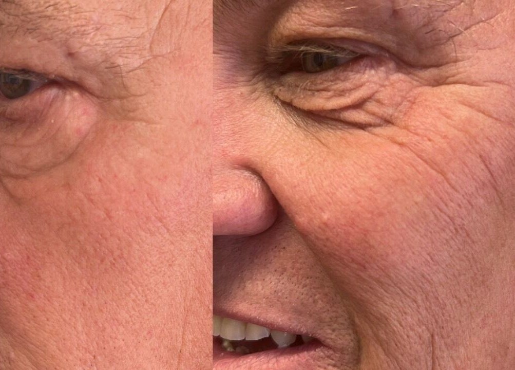 Before and after skin treatment at Lowes Lashes Aesthetics Sunbed, Faversham, England, GB.