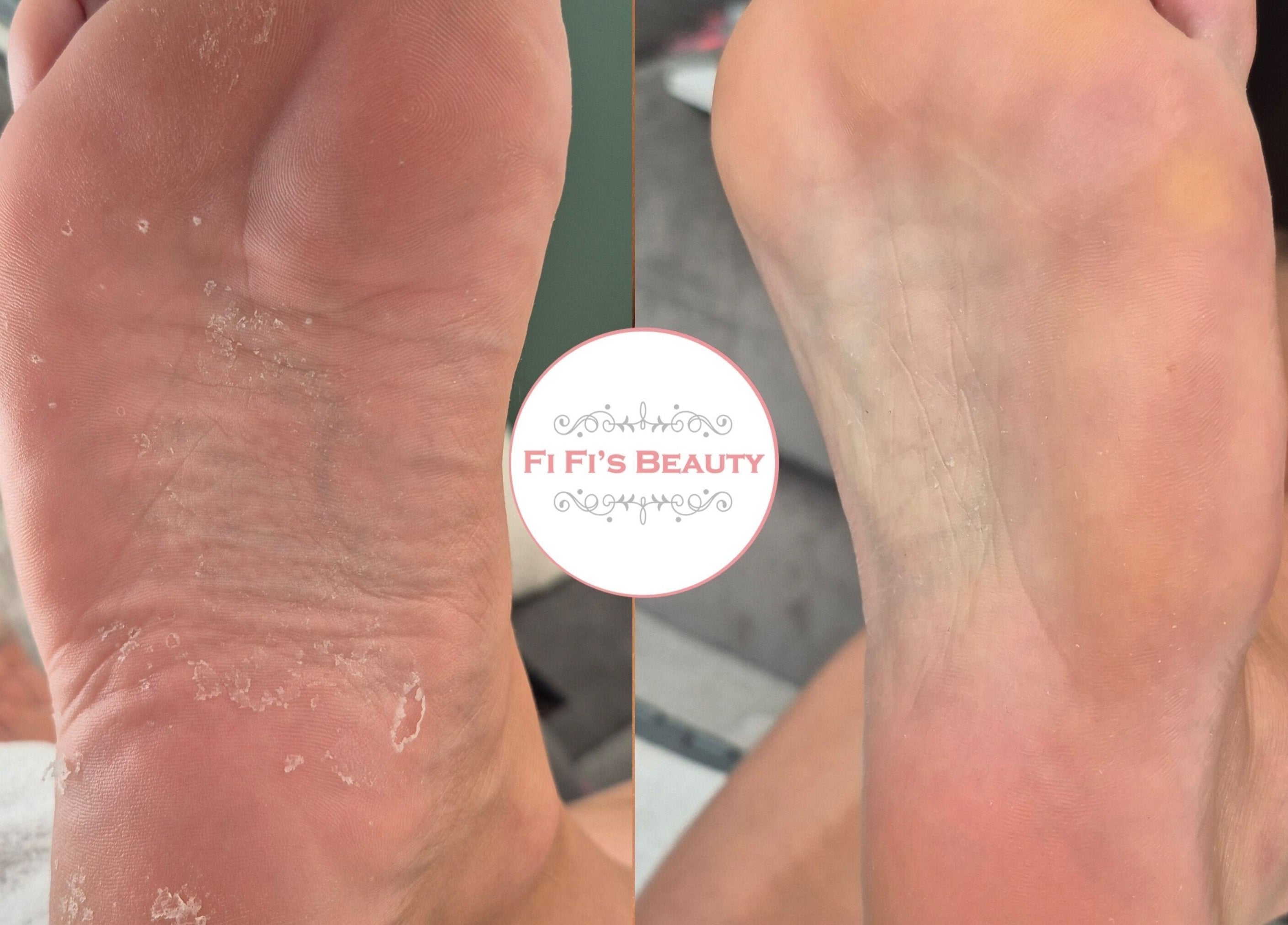 Foot transformation at Fi Fi's Beauty in Fareham, England, GB showcasing smooth, rejuvenated skin.