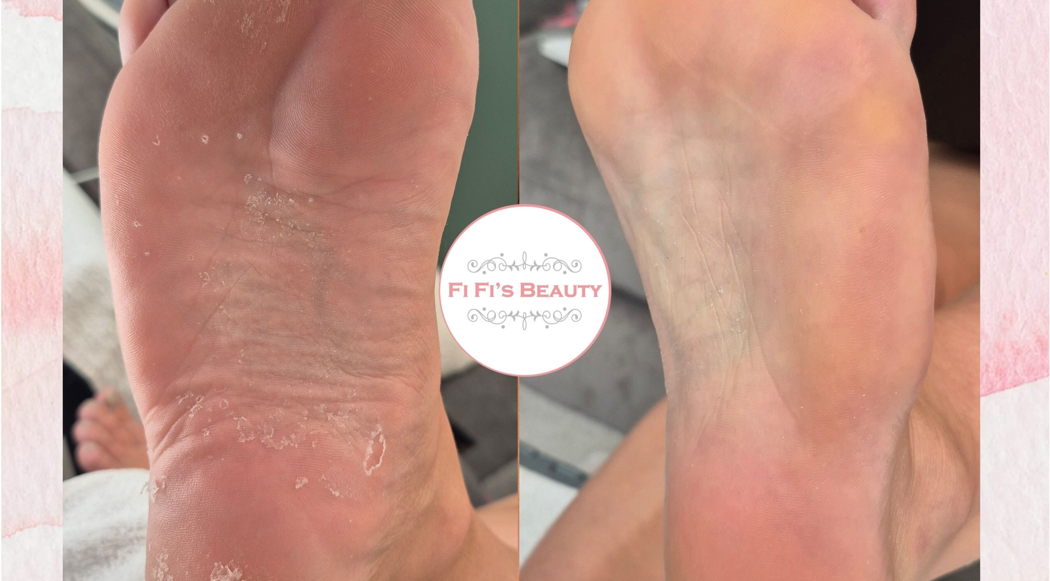 Foot transformation at Fi Fi's Beauty in Fareham, England, GB showcasing smooth, rejuvenated skin.