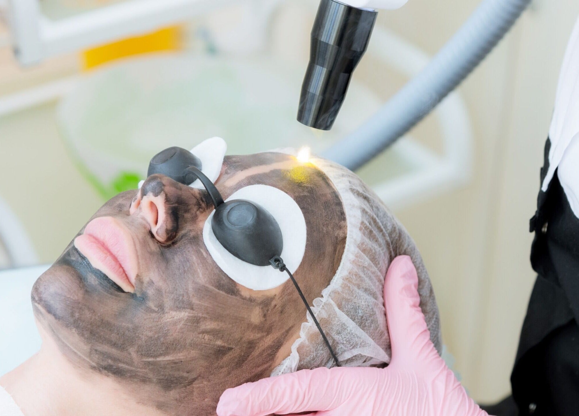 Carbon laser facial at Pulsar Laser Chorley in Chorley, England, GB showcasing rejuvenating skincare treatment.