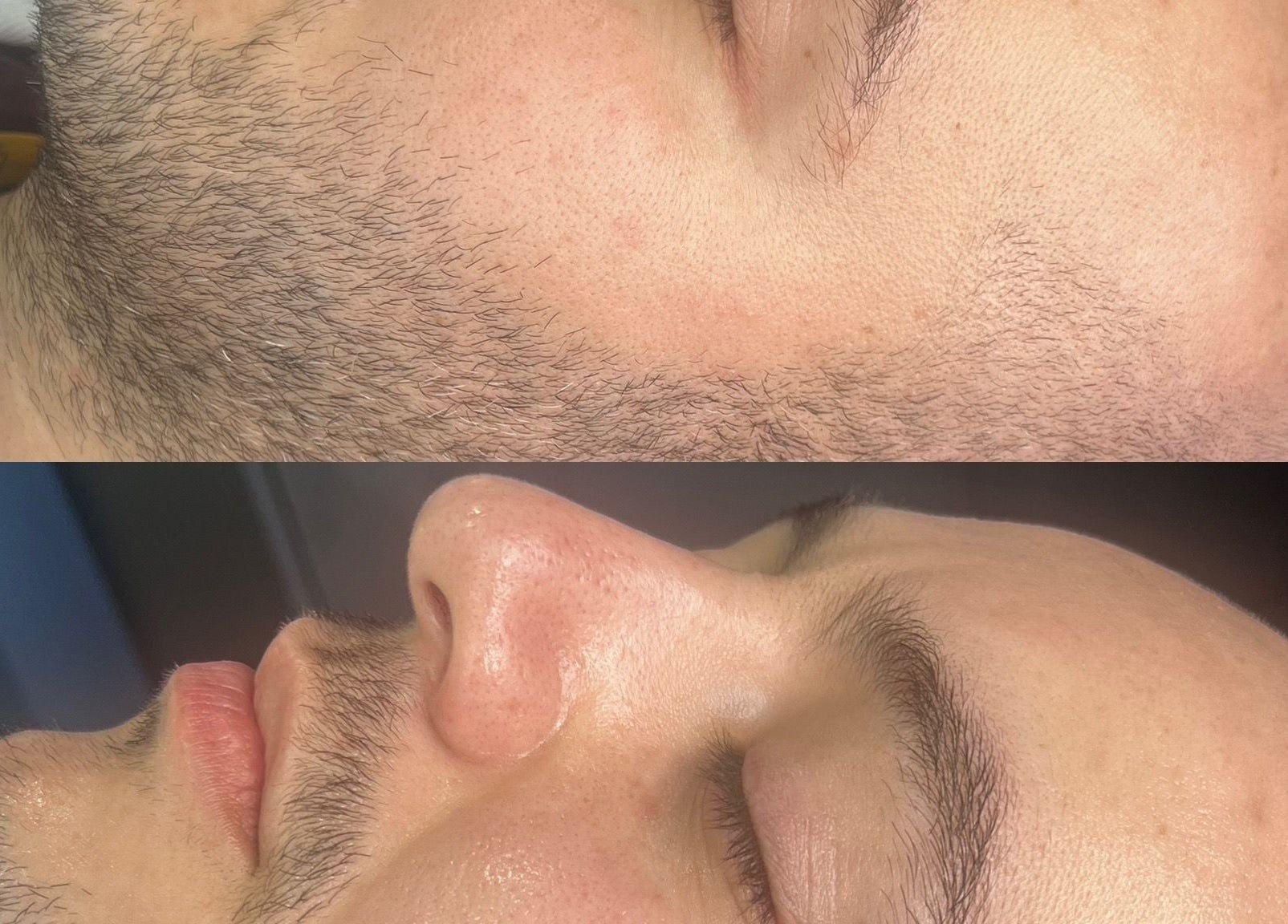 Before and after facial treatment at Pulsar Laser Chorley, showcasing improved skin texture, Chorley, England, GB.