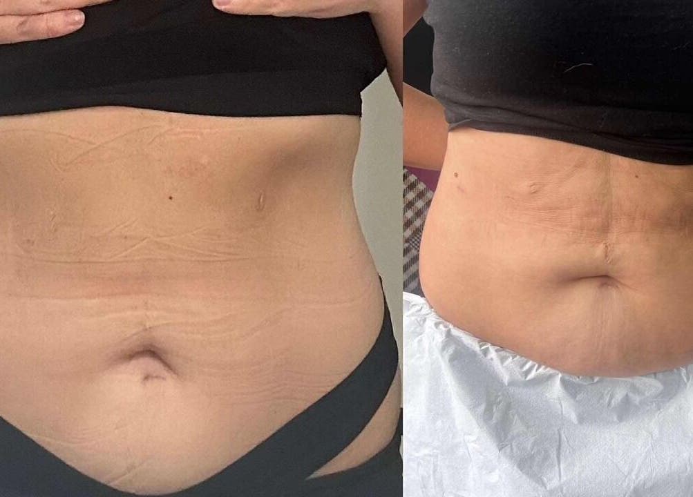 Before and after body contouring at Pulsar Laser Chorley, Chorley, England, GB showcasing treatment results.