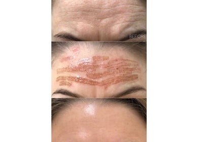Forehead treatment results at Complete Care Therapy in Ashmore, Queensland, AU showcasing before and after images.