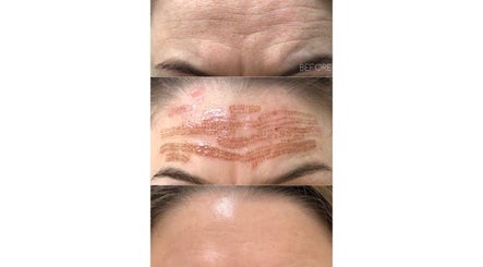 Forehead treatment results at Complete Care Therapy in Ashmore, Queensland, AU showcasing before and after images.