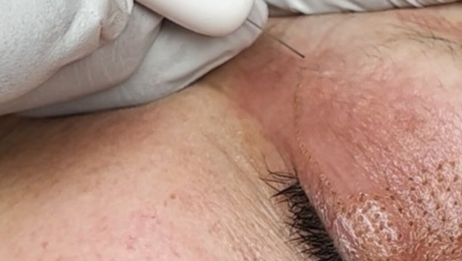 Aesthetic skin treatment procedure at Complete Care Therapy, Ashmore, Queensland, AU.