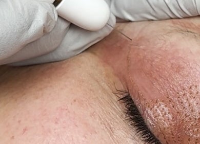 Aesthetic skin treatment procedure at Complete Care Therapy, Ashmore, Queensland, AU.
