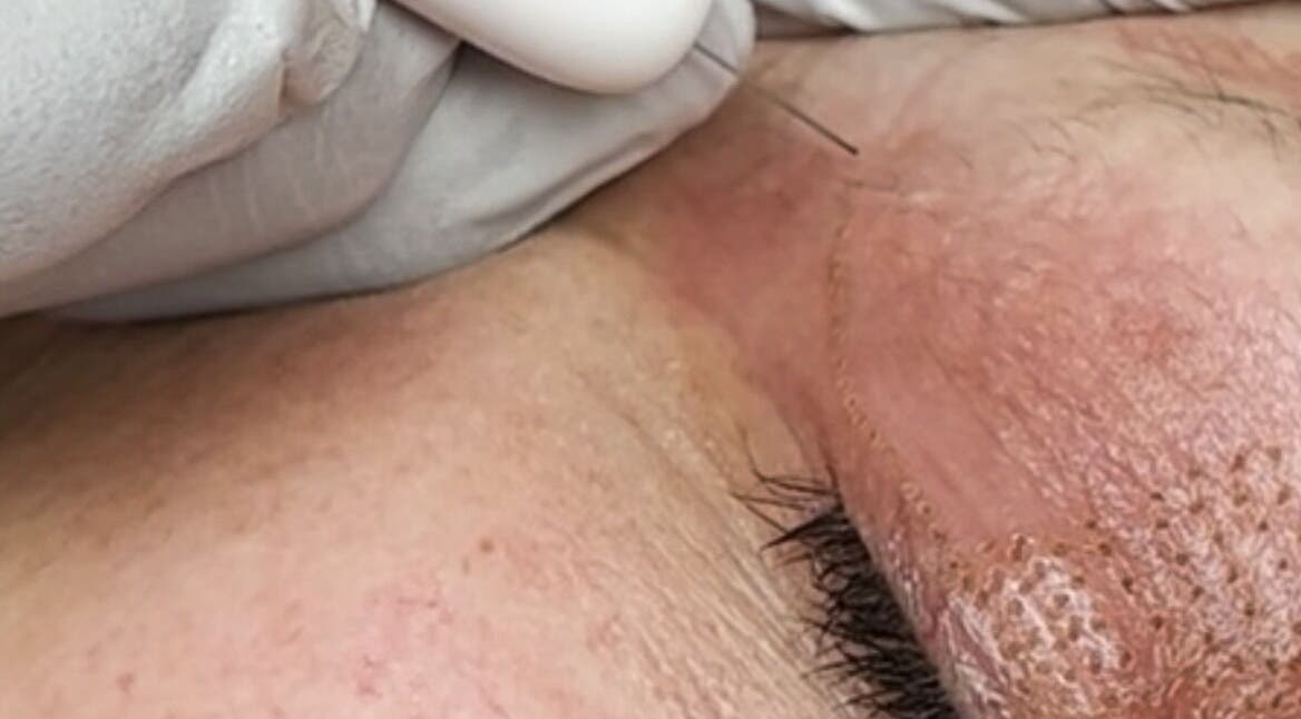 Aesthetic skin treatment procedure at Complete Care Therapy, Ashmore, Queensland, AU.