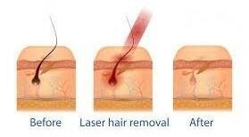 Illustration of laser hair removal process at Absolute Beauty Aesthetic Clinic and Spa, Johannesburg, Gauteng, ZA.