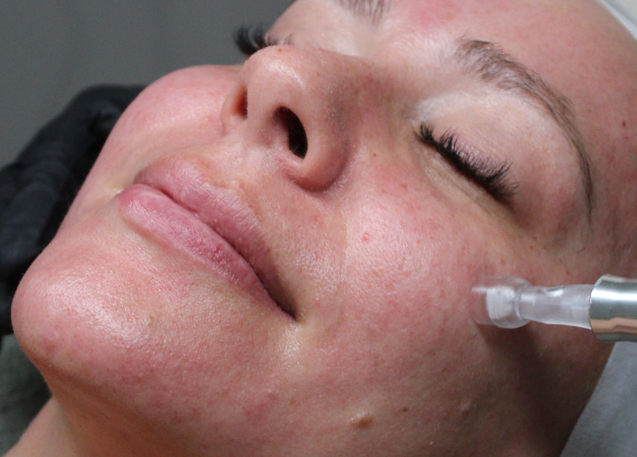 Facial treatment at Sattva Aesthetics, Caringbah, New South Wales, AU. Experience rejuvenation and skin care.