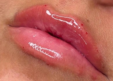 Lip enhancement at Holly’s Beauty Parlour in Romford, England, GB, showcasing glossy, full lips.