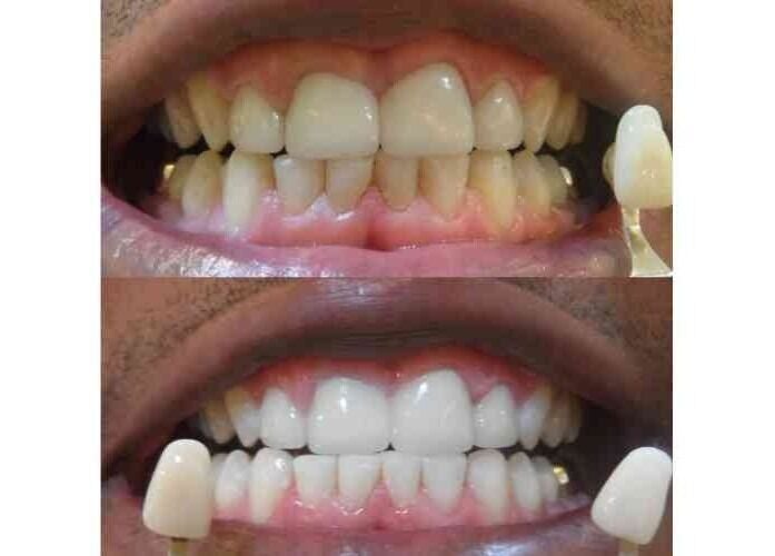 Before and after teeth whitening at After Glow Tanning & Beauty - North Providence, Rhode Island, US.