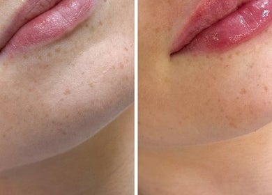 Before and after lip treatment at Advanced Aesthetics, Birkenhead, England, GB showing smoother skin texture.
