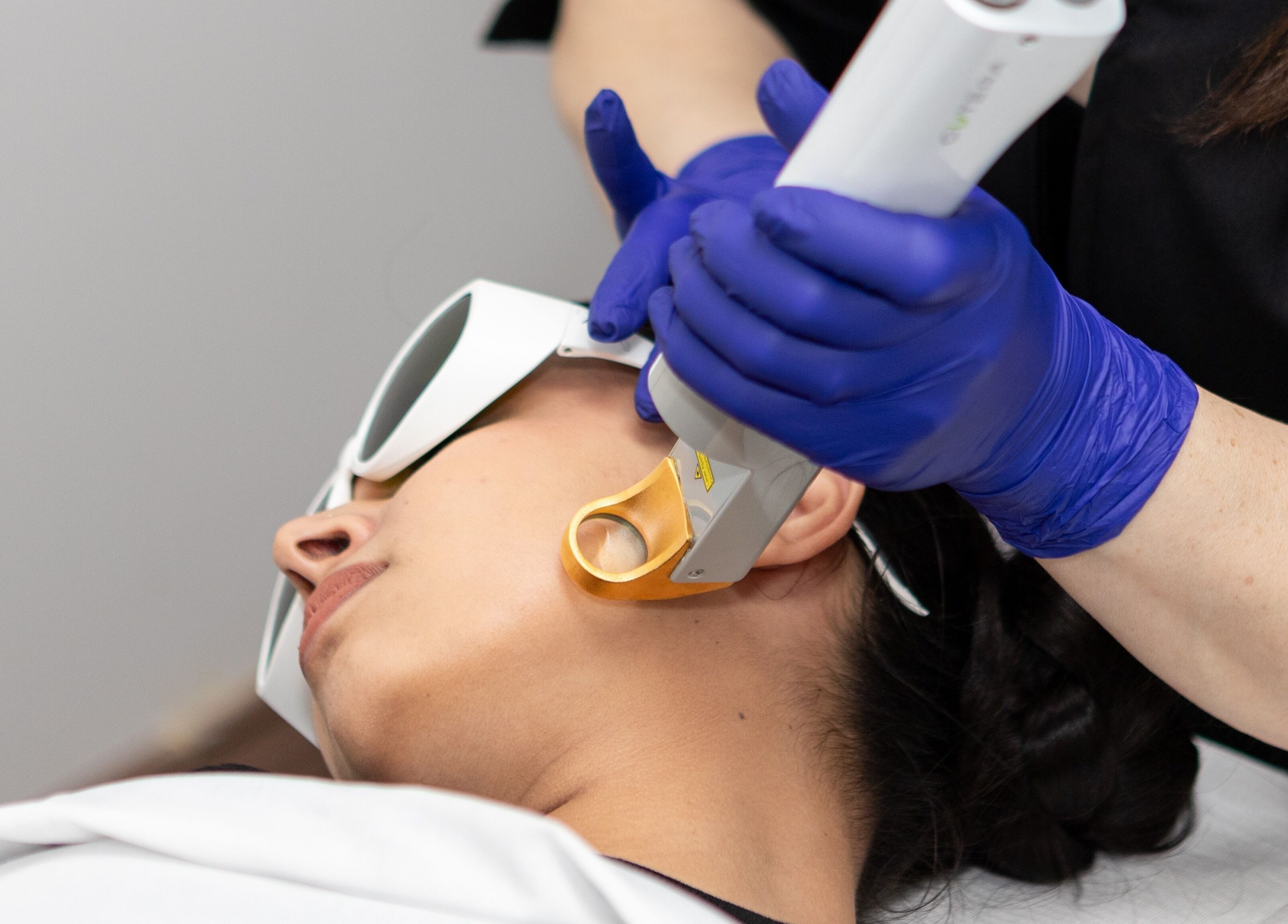 Laser treatment in progress at PLC Laser Clinic, Brampton, Ontario, CA, enhancing skin radiance.