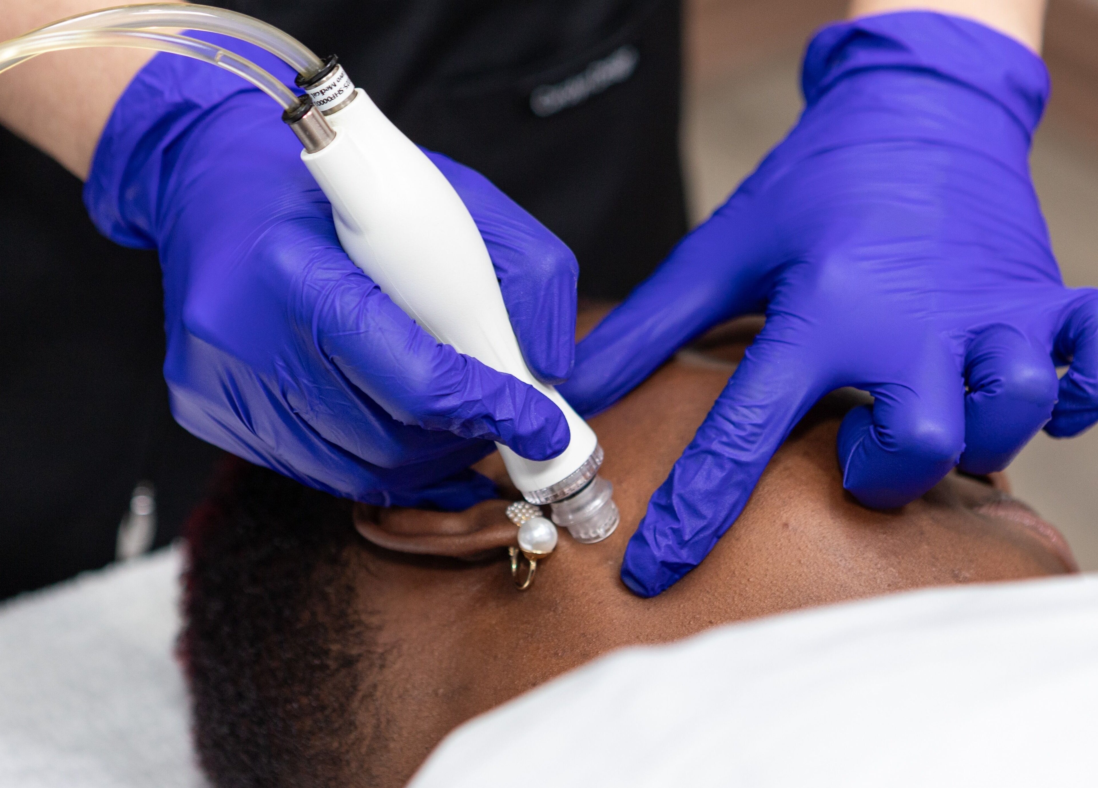 HydraFacial treatment at PLC Laser Clinic in Brampton, Ontario, CA, enhancing skin rejuvenation.